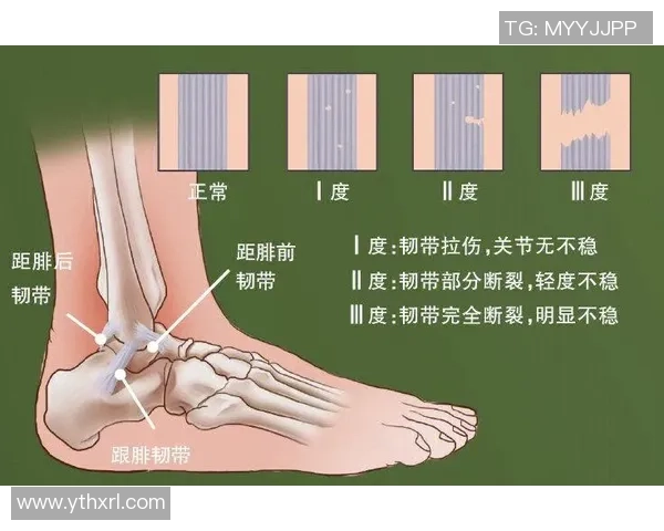 打篮球时韧带断裂的风险与预防措施详解 打篮球时韧带断裂的风险与预防措施详解